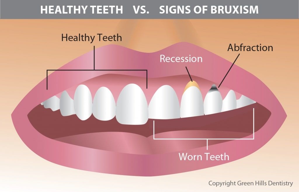 Signs of Bruxism