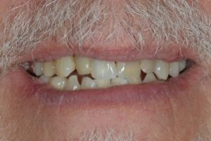 discolored and worn teeth