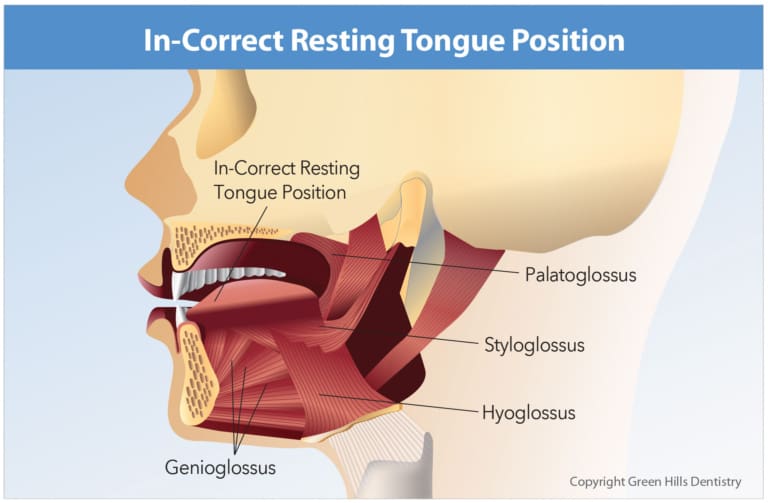 incorrect tongue resting position