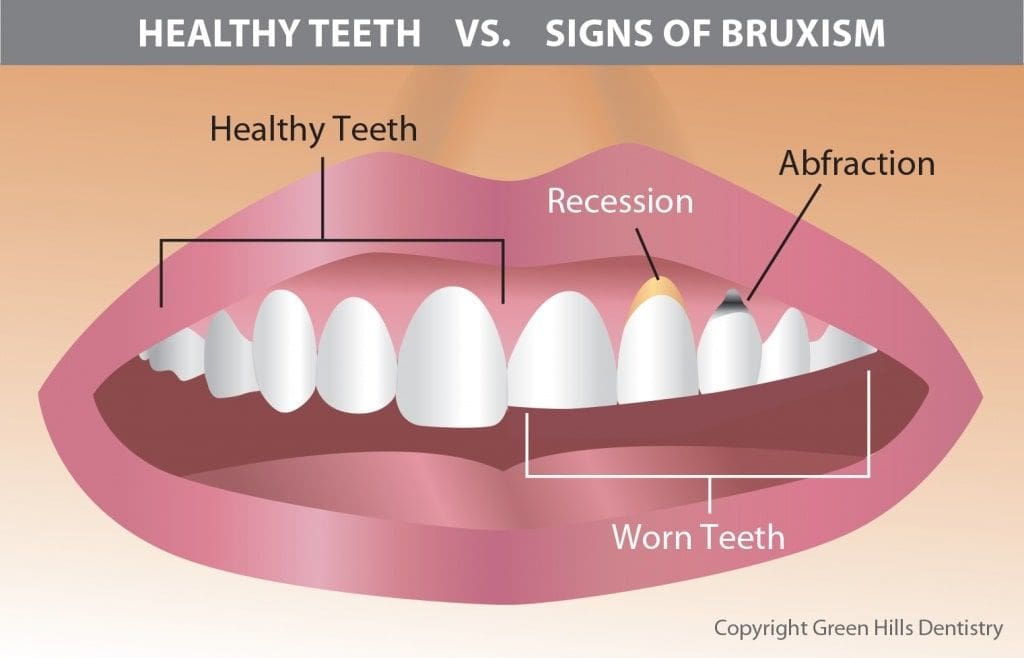 Bruxism treatment in Allentown, PA