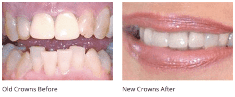 Dental Crowns In One Visit